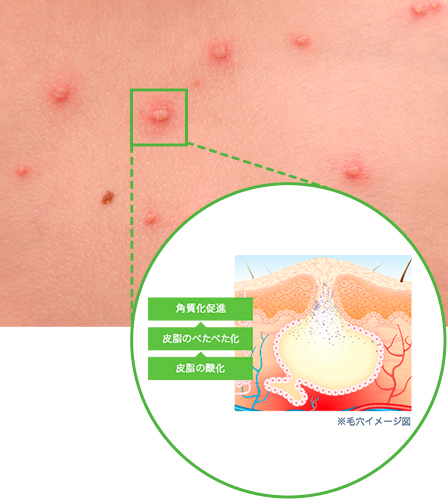 お肌について 敏感オイリー 混合肌 ビオデルマ公式サイト