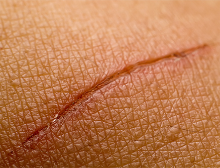お肌について ダメージをうけた肌 ビオデルマ公式サイト