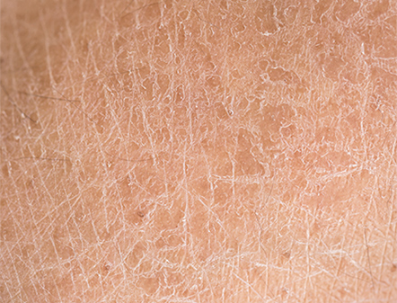 お肌について 乾燥肌 ビオデルマ公式サイト